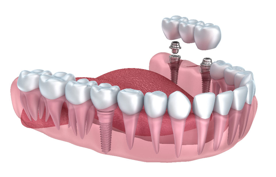Best Dental Implants Cost in Gurgaon, India